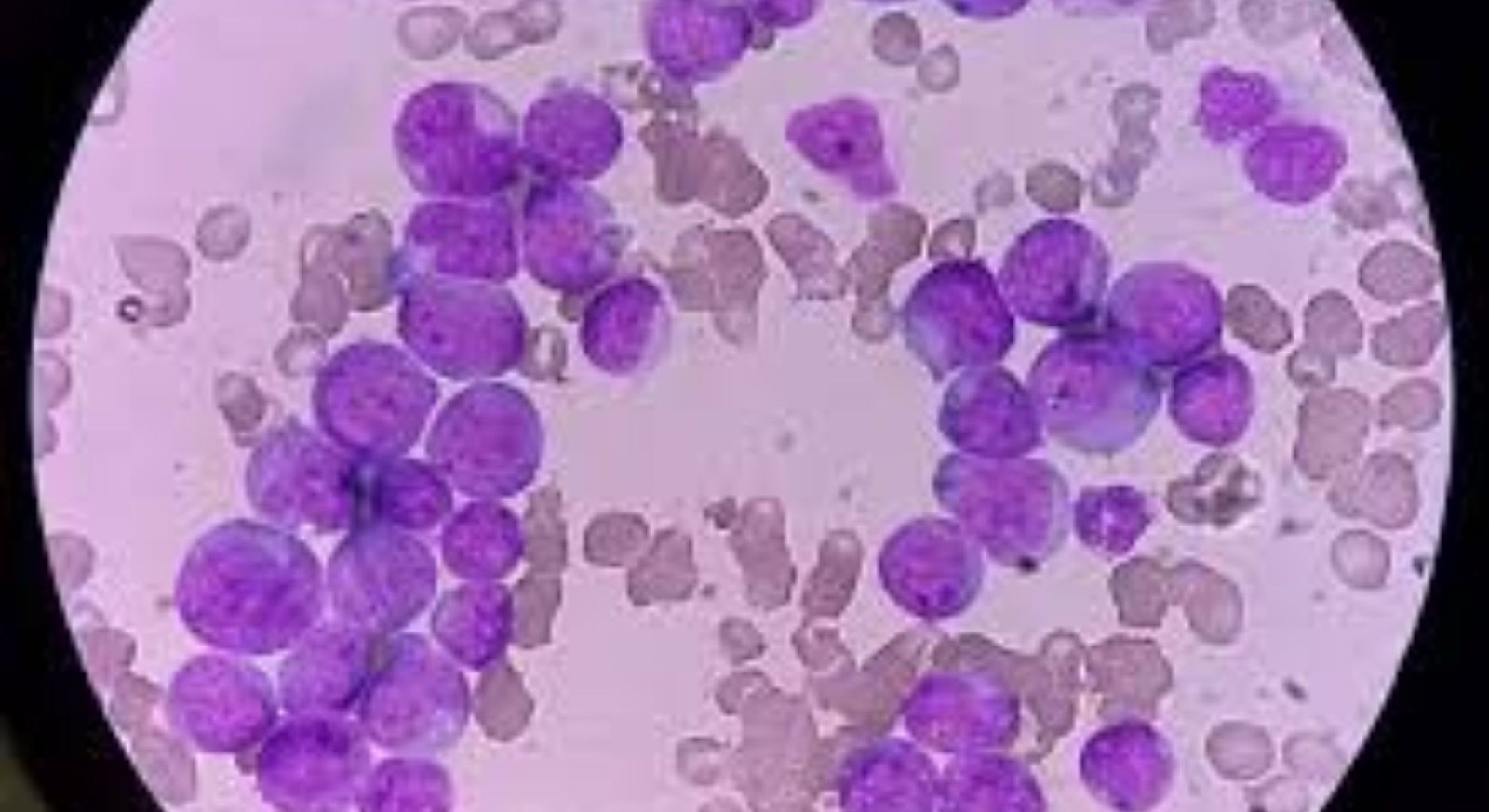 acute myeloid leukemia treatment image