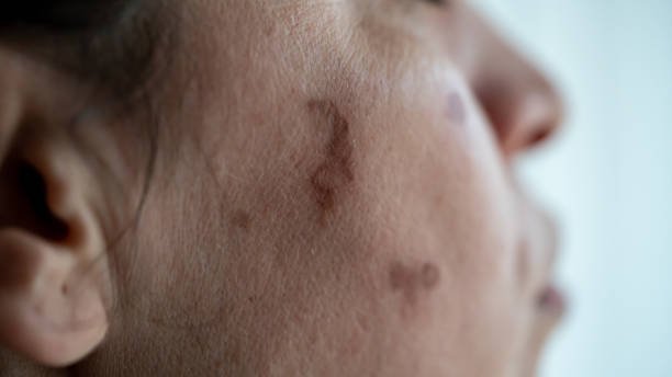 Port Wine Stain Birthmarks