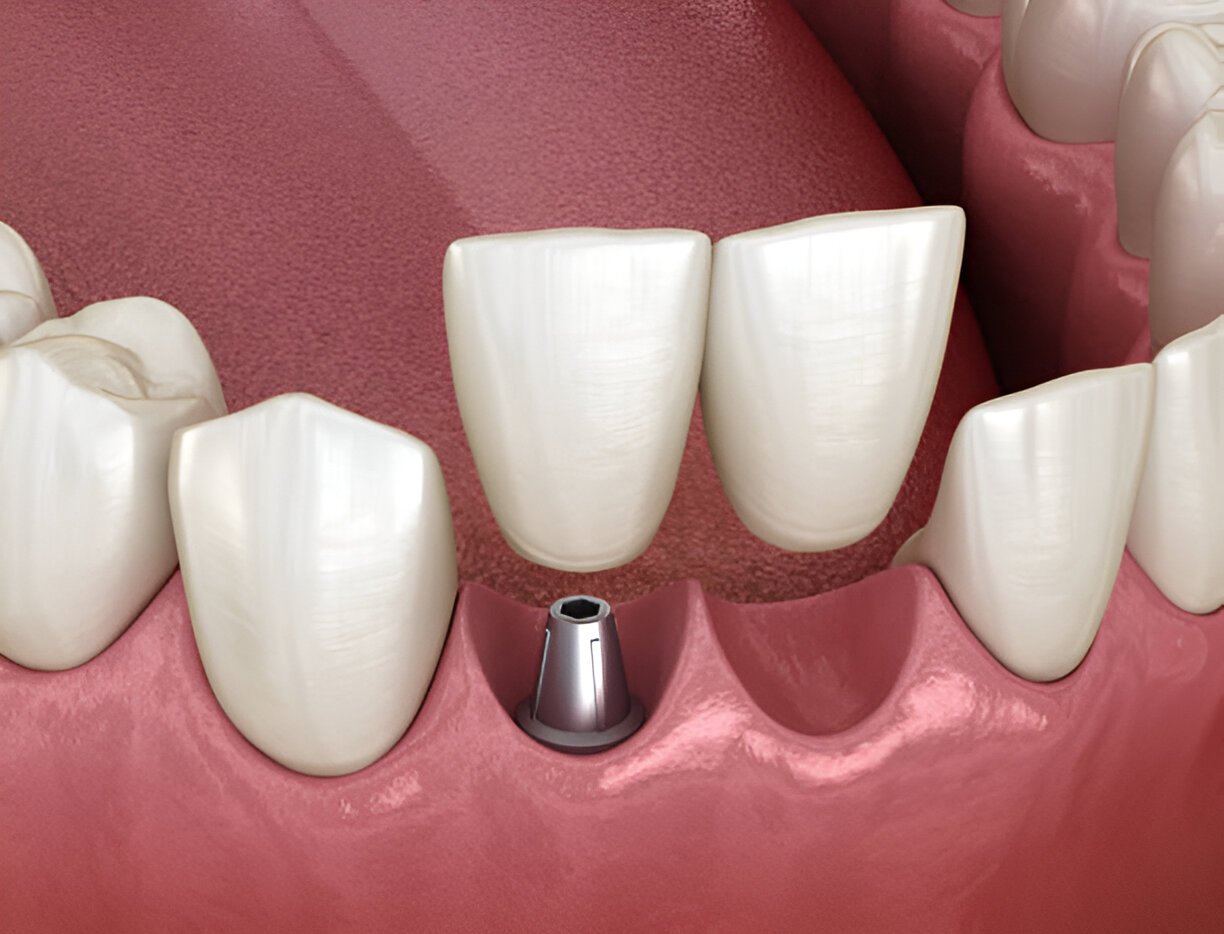 Dental implants Aberdeen