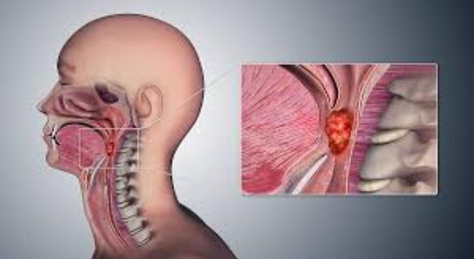 throat cancerTreatment images