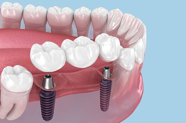 Dental Bridge in Kendal